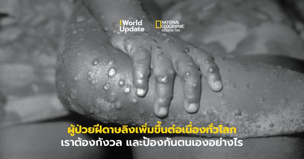 ฝีดาษลิง